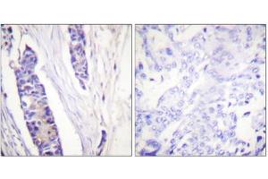 Immunohistochemistry analysis of paraffin-embedded human breast carcinoma tissue, using Tubulin beta antibody. (TUBB 抗体  (C-Term))