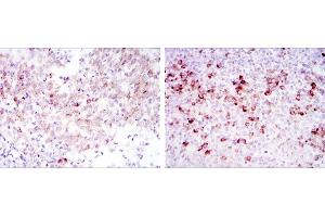 Immunohistochemical analysis of paraffin-embedded cervical cancer tissues (left) and tonsil tissues (right) using CTTN mouse mAb with DAB staining. (Cortactin 抗体)