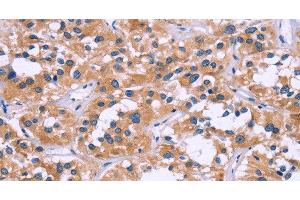 Immunohistochemistry of paraffin-embedded Human thyroid cancer tissue using ZEB2 Polyclonal Antibody at dilution 1:60 (ZEB2 抗体)