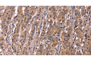 Immunohistochemistry of paraffin-embedded Human gastric cancer using SEPT7 Polyclonal Antibody at dilution of 1:50 (Septin 7 抗体)