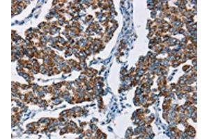 The image on the left is immunohistochemistry of paraffin-embedded Human breast cancer tissue using ABIN7129699(HINT2 Antibody) at dilution 1/50, on the right is treated with fusion protein. (HINT2 抗体)