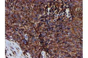 Immunohistochemical staining of paraffin-embedded Adenocarcinoma of Human breast tissue using anti-PDIA4 mouse monoclonal antibody. (PDIA4 抗体)