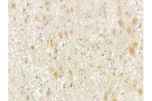 ABIN6261858 and ABIN6276889 at 1/100 staining human astrocytoma by IHC-P. (GABRA2 抗体  (N-Term))