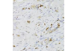 Immunohistochemistry of paraffin-embedded human adenomyosis using LSP1 Antibody (ABIN5973271) at dilution of 1/100 (40x lens). (LSP1 抗体)