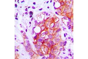 Immunohistochemical analysis of GAD1/2 staining in human breast cancer formalin fixed paraffin embedded tissue section. (GAD65+GAD67 (C-Term) 抗体)