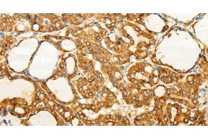 Immunohistochemistry of paraffin-embedded Human thyroid cancer tissue using FZD6 Polyclonal Antibody at dilution 1:60 (FZD6 抗体)