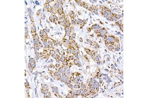 Immunohistochemistry of paraffin-embedded human esophageal cancer using MRPS15 Rabbit mAb (ABIN7268582) at dilution of 1:250 (40x lens). (MRPS15 抗体)