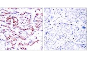 Immunohistochemistry analysis of paraffin-embedded human breast carcinoma, using ATF2 (Phospho-Ser112 or 94) Antibody. (ATF2 抗体  (pSer112))