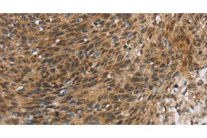 Immunohistochemistry of paraffin-embedded Human cervical cancer tissue using FOXB1 Polyclonal Antibody at dilution 1:30 (FOXB1 抗体)