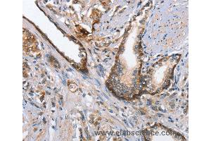 Immunohistochemistry of Human prostate cancer using MAD2L1BP Polyclonal Antibody at dilution of 1:65 (MAD2L1BP 抗体)