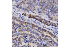 Immunohistochemistry of paraffin-embedded human thyroid cancer using SNCG antibody at dilution of 1:200 (x400 lens) (SNCG 抗体  (AA 1-127))