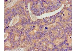 Immunohistochemistry of paraffin-embedded human colon cancer using ABIN7145766 at dilution of 1:100 (BCAR1 抗体  (AA 68-218))