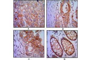 Immunohistochemical analysis of paraffin-embedded human lung cancer (A), colon cancer (B), breast cancer (C) and rectal cancer(D), using EPCAM mouse mAb with DAB staining. (EpCAM 抗体)