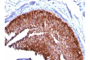 Formalin-fixed, paraffin-embedded human Bladder Carcinoma stained with CK17 Mouse Monoclonal Antibody (KRT17/778). (KRT17 抗体)