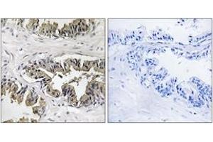 Immunohistochemistry analysis of paraffin-embedded human prostate carcinoma tissue, using GSPT1 Antibody. (GSPT1 抗体  (AA 101-150))
