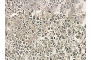 ABIN6255665 and ABIN6268972 at 1/100 staining human non-Hodgkin lymphoma by IHC-P.
