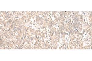 Immunohistochemistry of paraffin-embedded Human ovarian cancer tissue using ILKAP Polyclonal Antibody at dilution of 1:55(x200) (ILKAP 抗体)