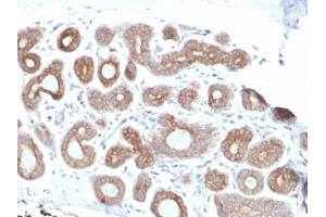 Formalin-fixed, paraffin-embedded human Breast Carcinoma stained with Calpain 1 Mouse Monoclonal Antibody (CAPN1/1530). (CAPNL1 抗体)