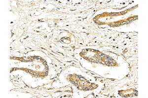 ABIN7094342 and ABIN7098389 at 1/100 staining Human pancreatic cancer by IHC-P. (LIN7C 抗体  (Internal Region))