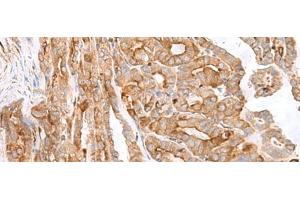 Immunohistochemistry of paraffin-embedded Human thyroid cancer tissue using MCAM Polyclonal Antibody at dilution of 1:40(x200) (MCAM 抗体)