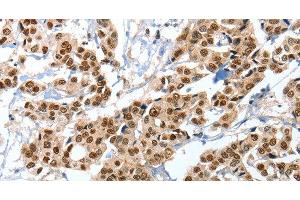 Immunohistochemistry of paraffin-embedded Human breast cancer tissue using ANXA10 Polyclonal Antibody at dilution 1:35 (Annexin a10 抗体)