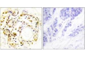 Immunohistochemistry analysis of paraffin-embedded human breast carcinoma, using ERK3 (Phospho-Ser189) Antibody. (MAPK6 抗体  (pSer189))