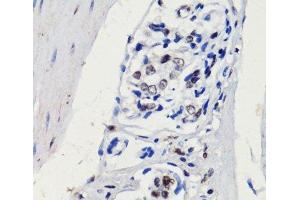 Immunohistochemistry of paraffin-embedded Human gastric cancer using p27 KIP 1 Polyclonal Antibody at dilution of 1:100 (40x lens). (CDKN1B 抗体)