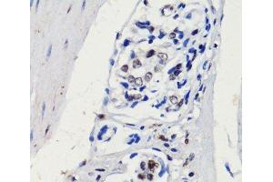 Immunohistochemistry of paraffin-embedded Human gastric cancer using p27 KIP 1 Polyclonal Antibody at dilution of 1:100 (40x lens).