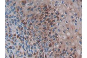 IHC-P analysis of Human Skin cancer Tissue, with DAB staining. (CCL3L1 抗体  (AA 1-93))