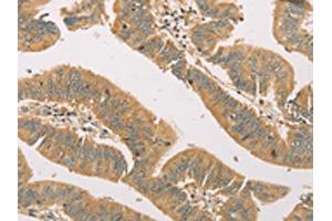 The image on the left is immunohistochemistry of paraffin-embedded Human colon cancer tissue using ABIN7131118(SNAP91 Antibody) at dilution 1/20, on the right is treated with fusion protein. (SNAP91 抗体)