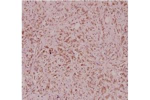 Immunohistochemistry analysis of Defensin alpha-3 Antibody in paraffin-embedded human breast carcinoma tissue at 1/100. (DEFa3 抗体)