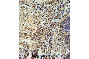 ZNF720 Antibody (Center) immunohistochemistry analysis in formalin fixed and paraffin embedded human lung carcinoma followed by peroxidase conjugation of the secondary antibody and DAB staining. (ZNF720 抗体  (Middle Region))
