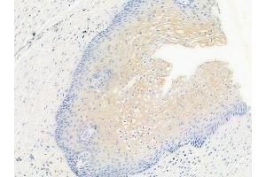 ABIN6256156 and ABIN6267546 at 1/100 staining human cervical carcinoma by IHC-P.