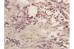 Formalin-fixed and paraffin embedded human lung carcinoma labeled with Rabbit Anti-CD101 Polyclonal Antibody, Unconjugated (ABIN2172703) at 1:200 followed by conjugation to the secondary antibody and DAB staining (CD101 抗体  (AA 51-150))