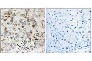 Immunohistochemistry analysis of paraffin-embedded human breast carcinoma tissue using CGREF1 antibody. (CGREF1 抗体  (C-Term))