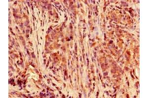 Immunohistochemistry of paraffin-embedded human pancreatic cancer using ABIN7150430 at dilution of 1:100