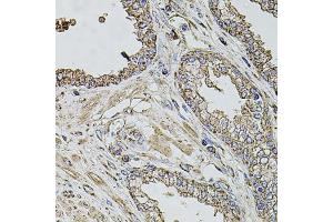 Immunohistochemistry of paraffin-embedded human prostate using TMC1 antibody (ABIN6134923, ABIN6149240, ABIN6149242 and ABIN6224704) at dilution of 1:100 (40x lens).