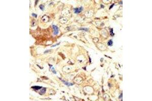 Formalin-fixed and paraffin-embedded human cancer tissue reacted with the primary antibody, which was peroxidase-conjugated to the secondary antibody, followed by AEC staining. (EGFR 抗体  (N-Term))