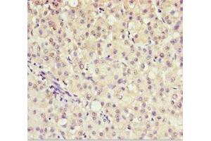 Immunohistochemistry of paraffin-embedded human liver cancer using ABIN7143586 at dilution of 1:100 (AKR7A2 抗体  (AA 100-359))