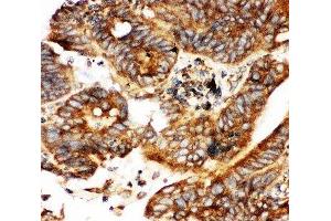 IHC-P testing of human intestinal cancer tissue (CALB1 抗体  (AA 2-175))