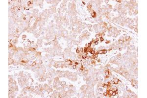 IHC-P Image Immunohistochemical analysis of paraffin-embedded OVCAR3 xenograft, using alpha 2 Antiplasmin, antibody at 1:500 dilution.