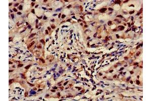 Immunohistochemistry of paraffin-embedded human lung cancer using ABIN7144852 at dilution of 1:100 (ATP5F1D 抗体  (AA 32-158))