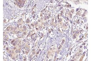 ABIN6267469 at 1/100 staining human breast carcinoma tissue sections by IHC-P. (CDC25C 抗体  (pSer216))