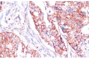 Immunohistochemistry of paraffin-embedded Human colon carcinoma using RPL24 Polyclonal Antibody at dilution of 1:100 (40x lens). (RPL24 抗体)