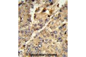 Formalin-fixed and paraffin-embedded human hepatocarcinoma reacted with XDH Antibody (N-term), which was peroxidase-conjugated to the secondary antibody, followed by DAB staining. (XDH 抗体  (N-Term))