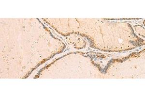 Immunohistochemistry of paraffin-embedded Human thyroid cancer tissue using IP6K3 Polyclonal Antibody at dilution of 1:50(x200) (IP6K3 抗体)