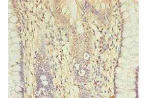 Immunohistochemistry of paraffin-embedded human colon cancer using ABIN7149384 at dilution of 1:100 (AGBL2 抗体  (AA 10-270))