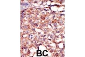 Formalin-fixed and paraffin-embedded human cancer tissue reacted with the primary antibody, which was peroxidase-conjugated to the secondary antibody, followed by AEC staining. (RIPK4 抗体  (C-Term))