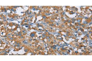 Immunohistochemistry of paraffin-embedded Human thyroid cancer tissue using KLF7 Polyclonal Antibody at dilution 1:40 (KLF7 抗体)