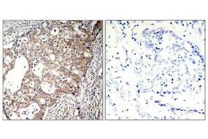 Immunohistochemical analysis of paraffin-embedded human breast carcinoma tissue using Shc1(Phospho-Tyr427) Antibody(left) or the same antibody preincubated with blocking peptide(right). (SHC1 抗体  (pTyr427))